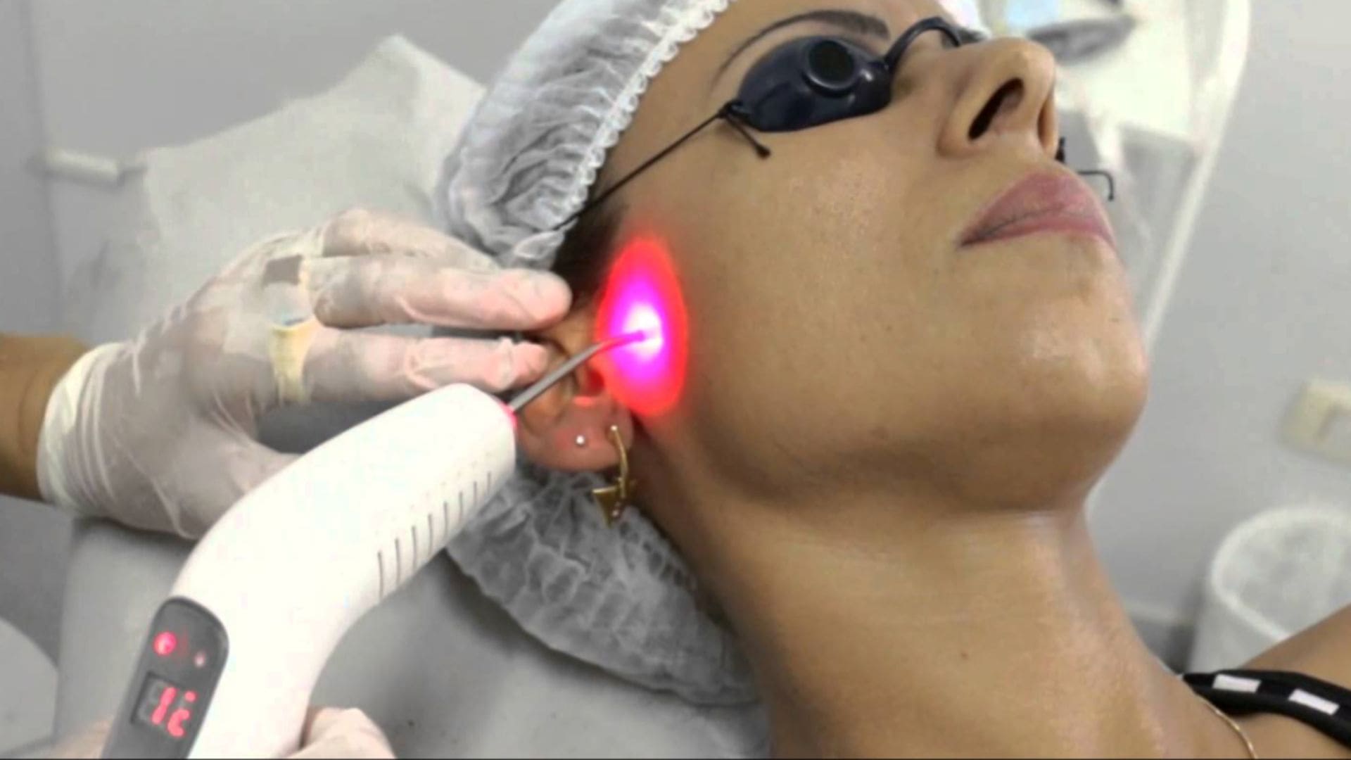 Leia mais sobre o artigo Laser de Baixa Intensidade (LLLT)